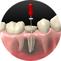 根管治療・歯内療法